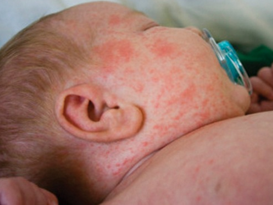 penyebab-alergi-kulit-pada-bayi